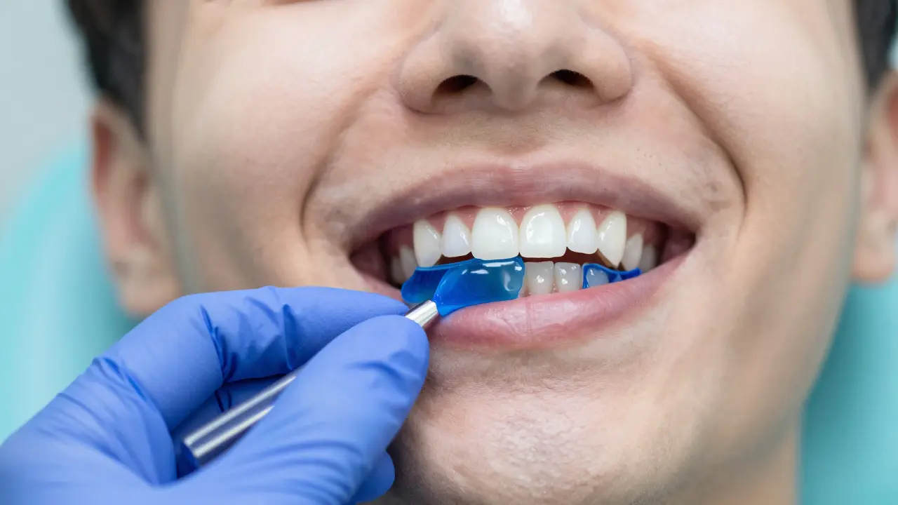 Jak probíhá profesionální bělení zubů v ordinaci: Průvodce metodami a průběhem